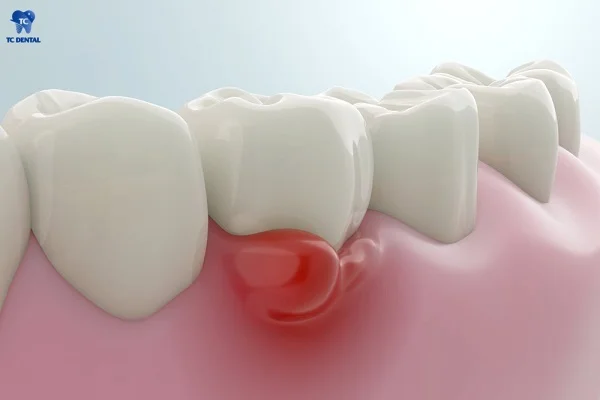 Sưng đỏ là dấu hiệu của viêm chân răng