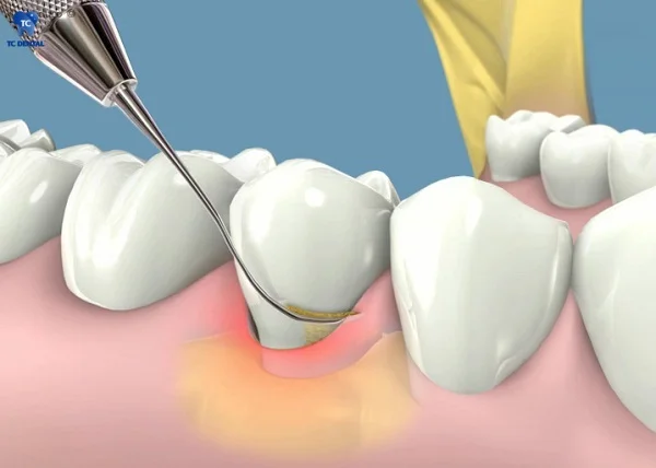 Bác sĩ cạo vôi răng và làm sạch gốc răng
